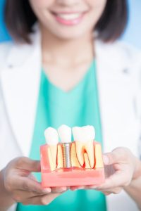 dental implants