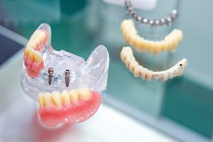 dental implants in model