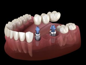 implant-supported dental bridge