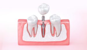 3 parts of the dental implant