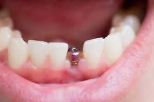 single-tooth dental implant